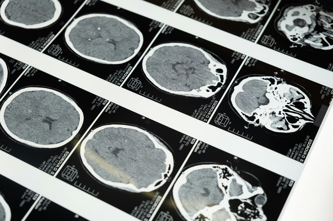 How Exercise Helps People with Parkinson’s Disease