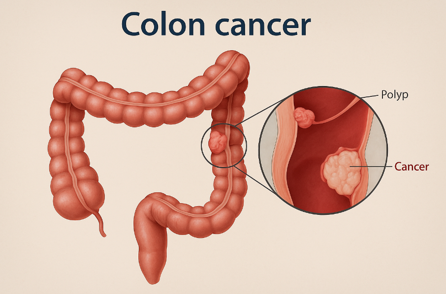 How Diet Affects Colon Cancer Risk