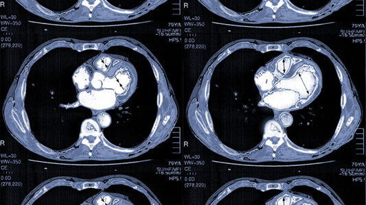 What Your Heart Scan May Be Missing