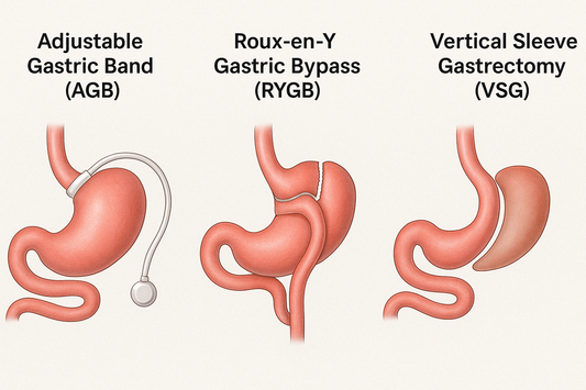 Which Weight Loss Surgery Works Best? A Big UK Study Has the Answer