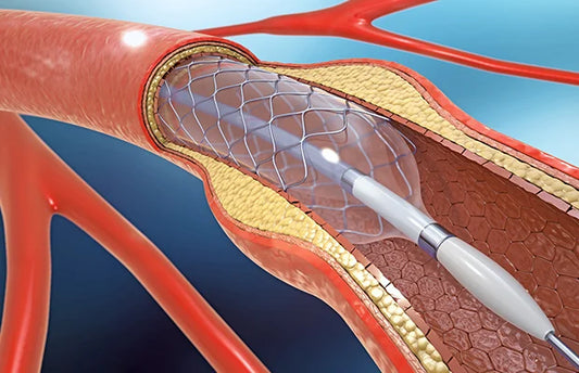 What Are Stents and Why Do We Use Them?